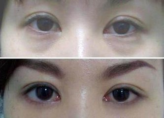 永康祛眼袋手术价格如何?