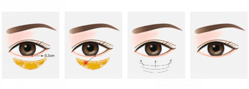 肇庆祛眼袋常用的方法有哪些?