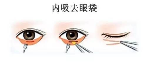 肇庆祛眼袋常用的方法有哪些?