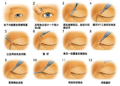 武汉内眦赘皮矫正有哪些优点?