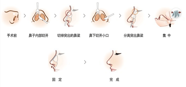 武汉鼻尖整形的方法有哪些?