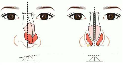 武汉歪鼻矫正术后如何保养?