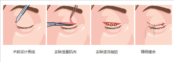 武汉切开双眼皮恢复要多久?