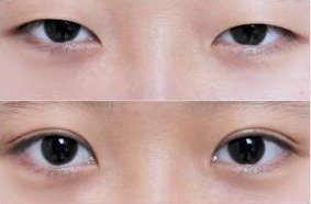 武汉埋线双眼皮适应症有哪些?