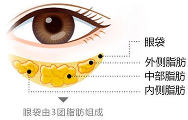 肇庆吸脂祛眼袋有哪些好处?
