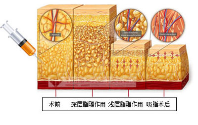 武汉背部吸脂减肥怎么样?