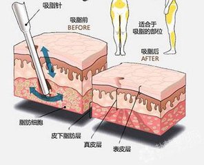 武汉产后吸脂减肥的价格是多少?