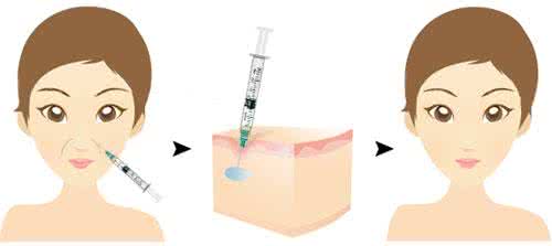 武汉玻尿酸去法令纹的价格是多少?