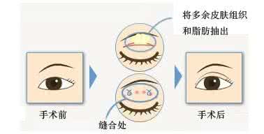 武汉做眼部吸脂会不会对眼睛造成伤害?