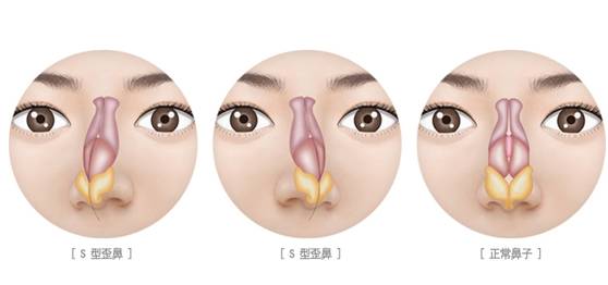 武汉歪鼻矫正手术价格是多少?