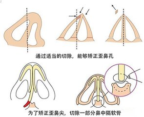 武汉歪鼻子整形的效果好不好?