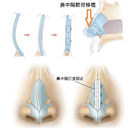 武汉歪鼻矫正手术价格是多少?