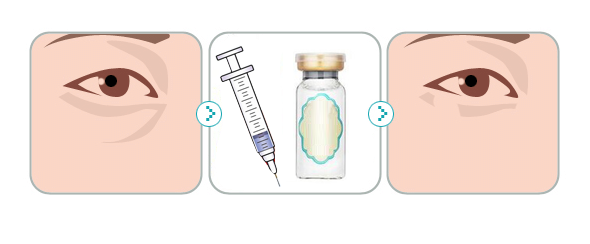 武汉注射玻尿酸填充泪沟吗?