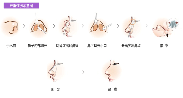 如何矫正驼峰鼻?