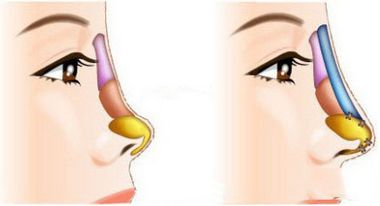 假体隆鼻效果可以维持多久?