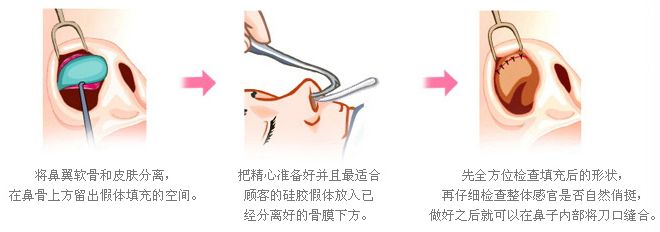 武汉隆鼻手术需要多久?