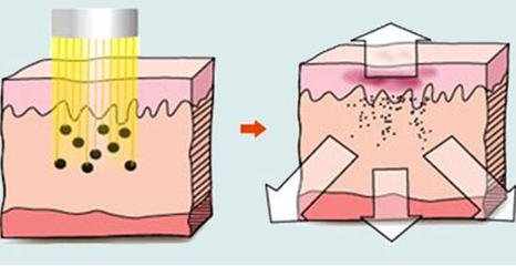 激光去除黄褐斑会不会反弹?