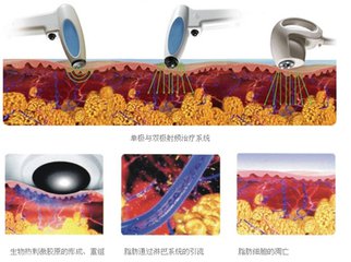 电波拉皮可以去除鱼尾纹吗?