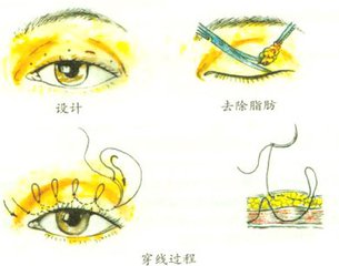 埋线双眼皮术后多久恢复正常?