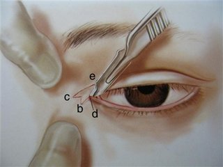 开眼角的恢复时间是多久?
