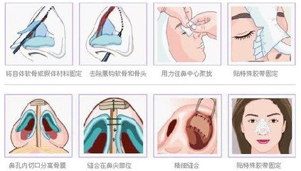 武汉隆鼻的费用是多少?