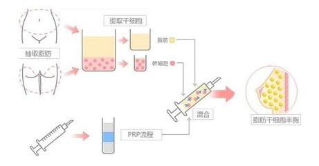 自体脂肪丰胸有哪些优点?