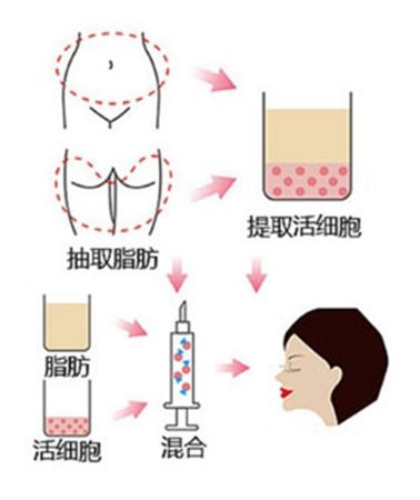 自体脂肪丰太阳穴可以保持多久?