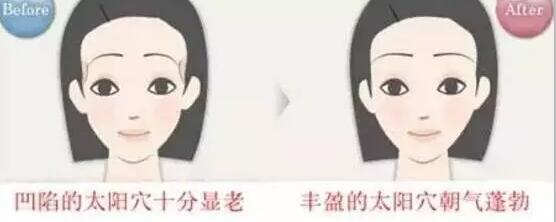 自体脂肪丰太阳穴术后如何保养?