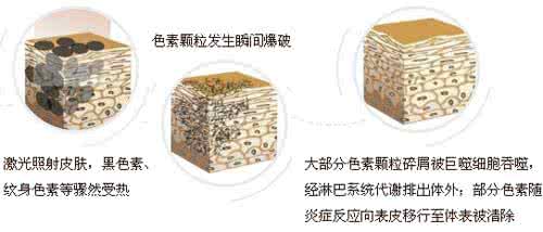 胎记,激光袪胎记,胎记治疗,胎痣