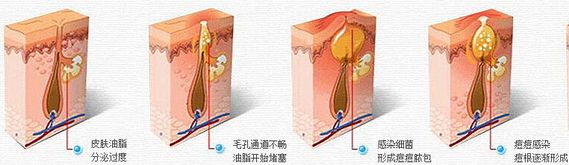 武汉怎样去除痘印比较有效?