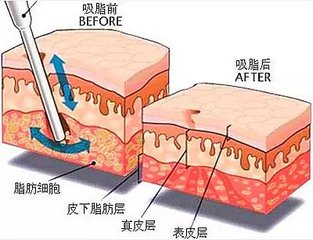 武汉腰部吸脂吗?