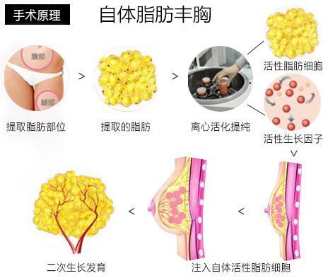 自体脂肪丰胸对健康有影响吗?