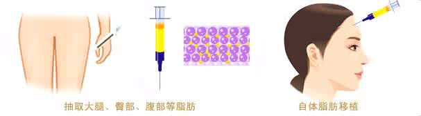 武汉自体脂肪丰额头怎样的?