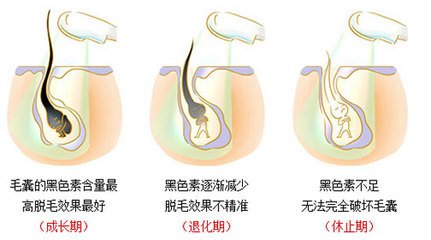 武汉冰点脱毛的特点有哪些?