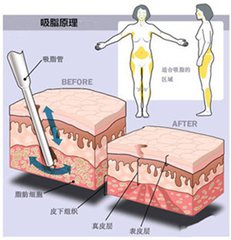 背部吸脂后护理有哪些?