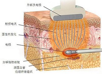 武汉背部吸脂的效果怎么样?