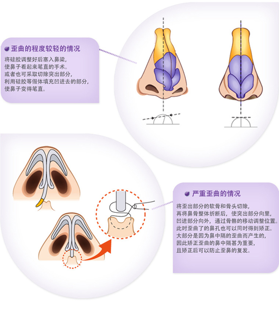 武汉歪鼻矫正整形的价格贵不贵