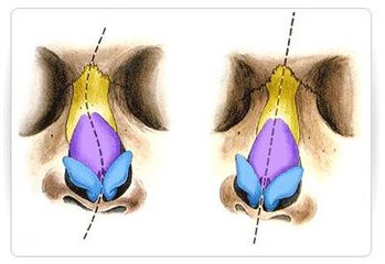 隆鼻后鼻子歪了怎么办?