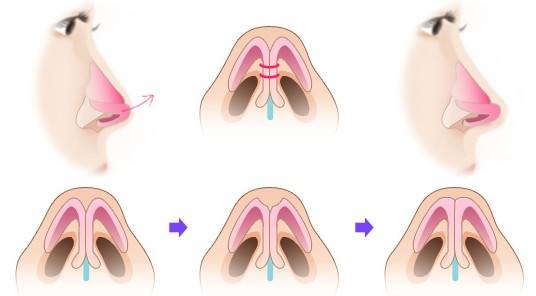 武汉鼻尖塑形的方法有哪些?