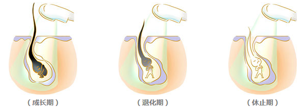艺星激光脱毛多少钱?