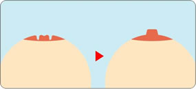 武汉做完乳头内陷矫正术后的注意事项?