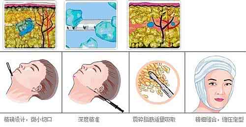 武汉面部吸脂瘦脸的价格是多少?