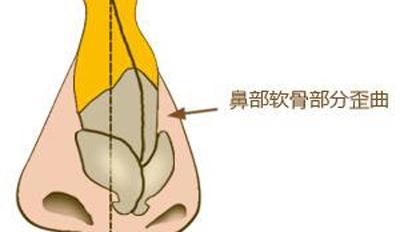 武汉歪鼻矫正后需要怎么护理