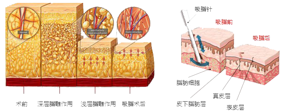 武汉背部吸脂会出现副作用吗?