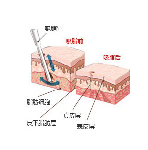 武汉背部吸脂效果怎么样?