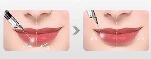 武汉玻尿酸丰唇的效果怎么样?