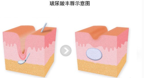 武汉艺星玻尿酸丰唇吗?