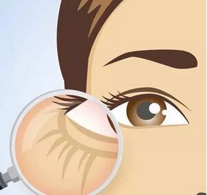 玻尿酸祛眼角纹后如何护理?