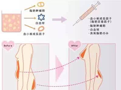 武汉自体脂肪注射丰臀吗?