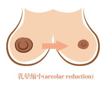 武汉乳晕过大需要怎么做